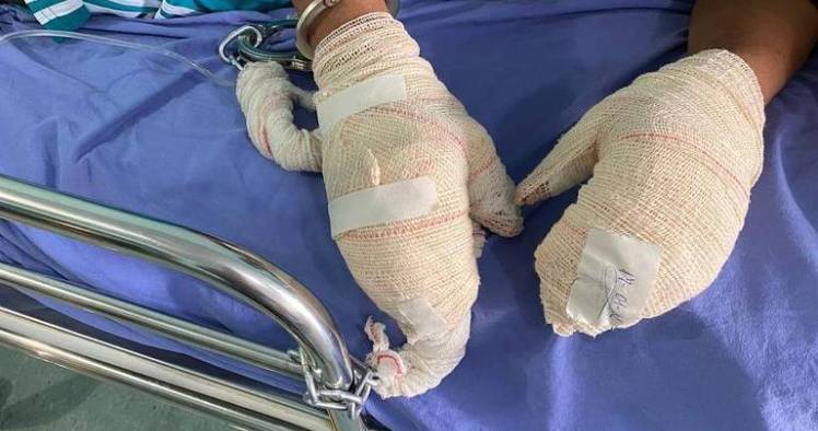 OAB denuncia surto de bactéria que provoca feridas e corrosão na pele de presos em Roraima